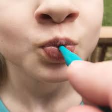 39MT048 - ARK Pro Button Set for lip closure